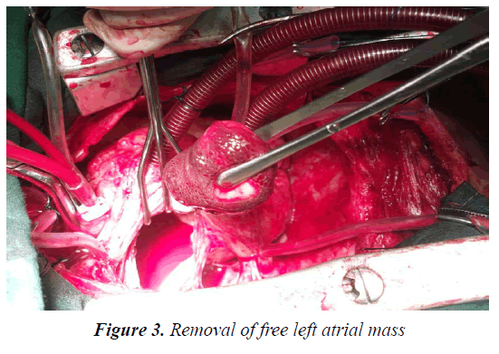 medical-oncology-therapeutics-atrial-mass