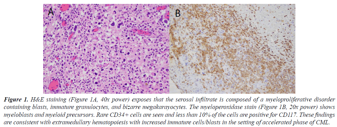 medical-oncology-therapeutics-serosal-infiltrate