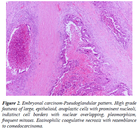 molecular-oncology-Embryonal-carcinom