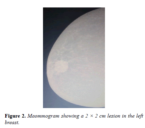 molecular-oncology-Maommogram-showing