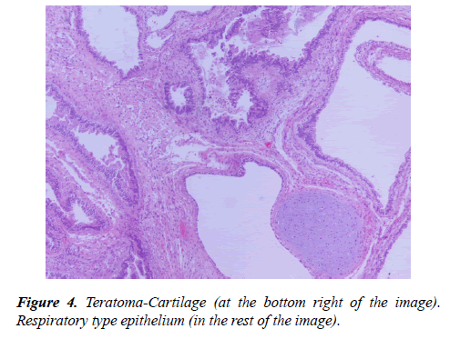 molecular-oncology-Teratoma-Cartilage