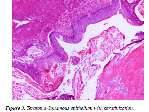 molecular-oncology-Teratoma-Squamous