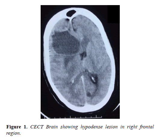 molecular-oncology-hypodense-lesion