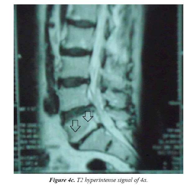 neuroinformatics-neuroimaging-hyperintense-signal