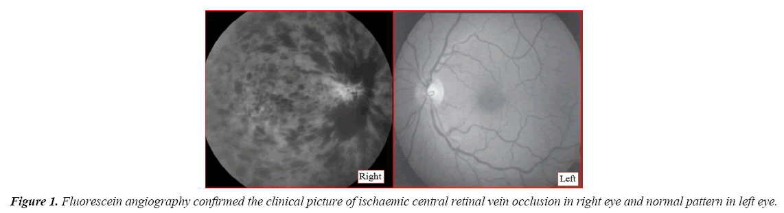 neurology-neurorehabilitation-research-Fluorescein-angiography