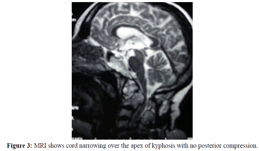 neurology-neurorehabilitation-research-MRI-narrowing-kyphosis