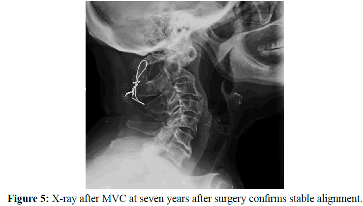 neurology-neurorehabilitation-research-MVC-surgery-confirms-alignment