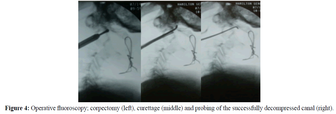 neurology-neurorehabilitation-research-Operative-fluoroscopy-corpectomy