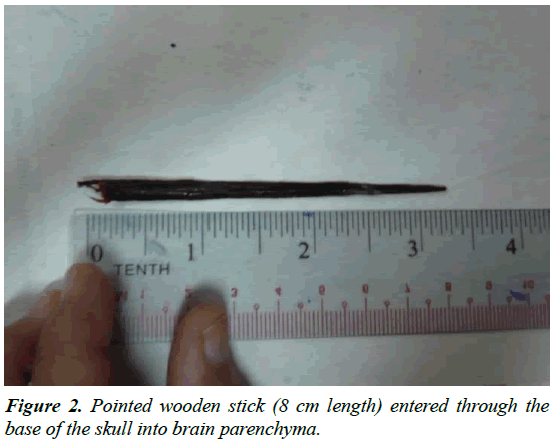 neurology-neurorehabilitation-research-Pointed-wooden-parenchyma