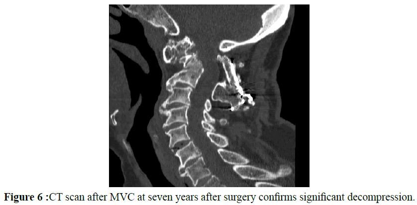 neurology-neurorehabilitation-research-seven-surgery-decompression