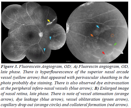 ophthalmic-and-eye-research-Fluorescein-Angiogram