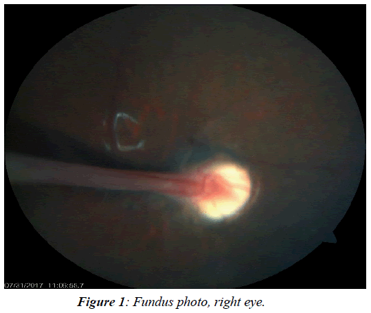 ophthalmic-and-eye-research-Fundus-photo