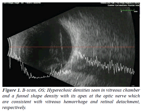 ophthalmic-and-eye-research-Hyperechoic-densities