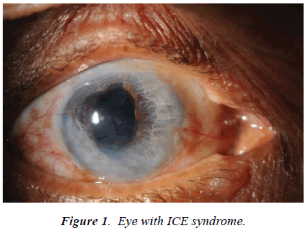 ophthalmic-and-eye-research-ICE-syndrome