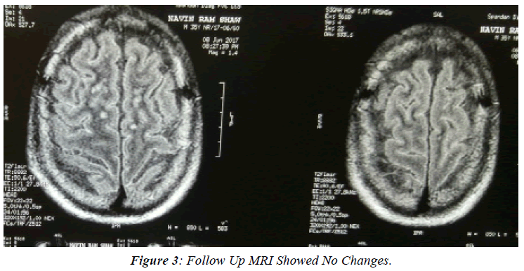 ophthalmic-and-eye-research-MRI-Showed