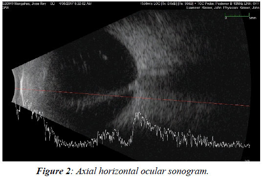 ophthalmic-and-eye-research-horizontal-ocular