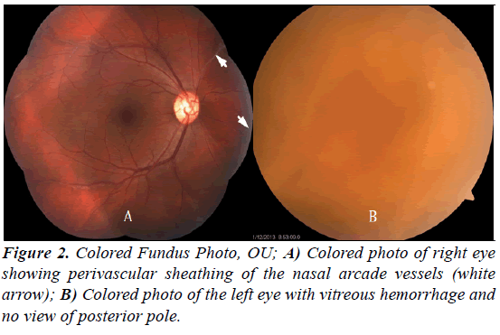 ophthalmic-and-eye-research-perivascular-sheathing