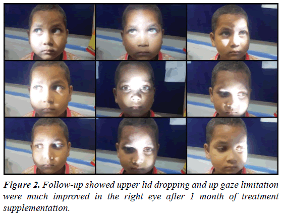 ophthalmic-and-eye-research-upper-lid