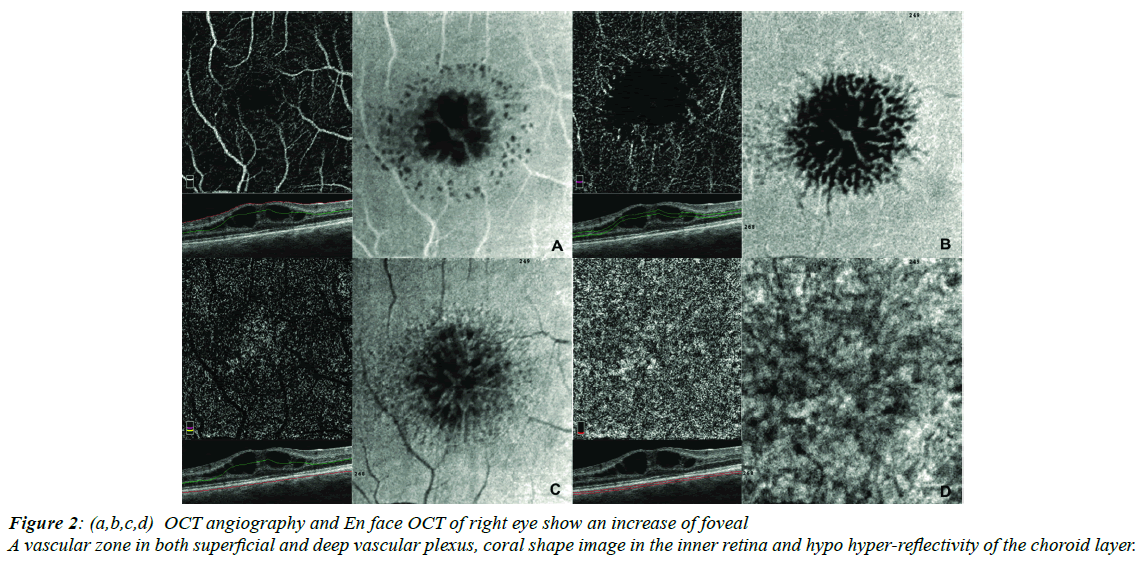 ophthalmic-and-eye-research-vascular-plexus