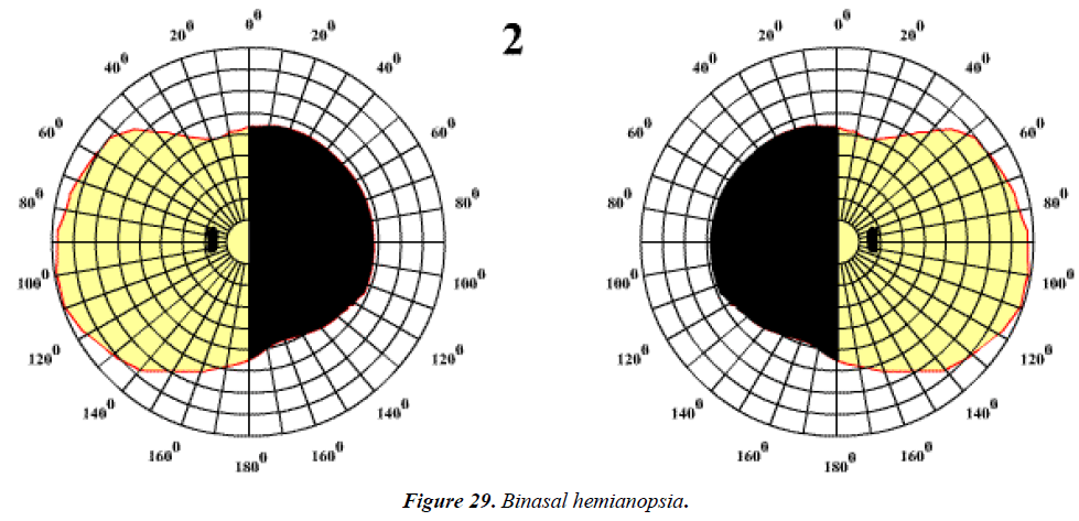 ophthalmic-eye-research-Binasal-hemianopsia