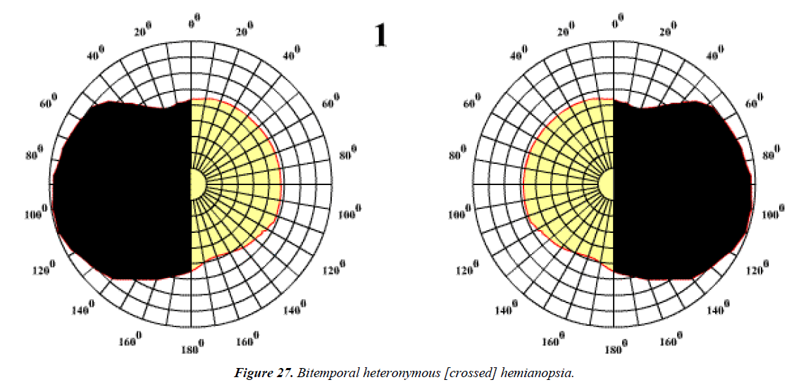 ophthalmic-eye-research-Bitemporal-heteronymous