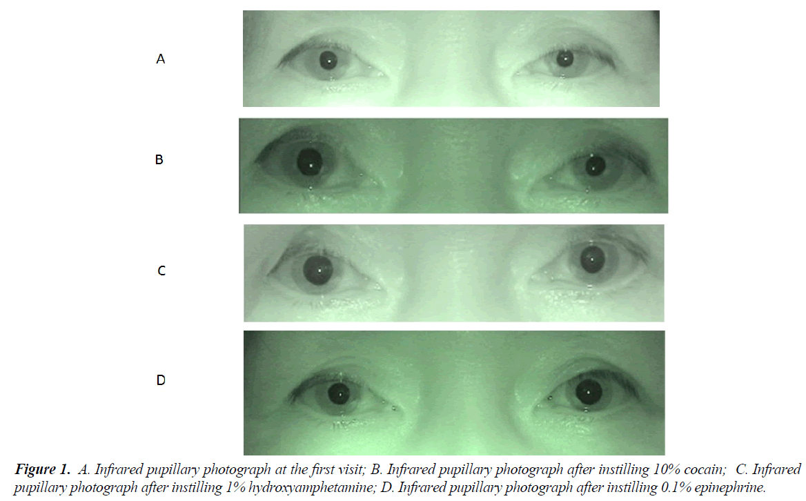 ophthalmic-eye-research-Infrared-pupillary-photograph