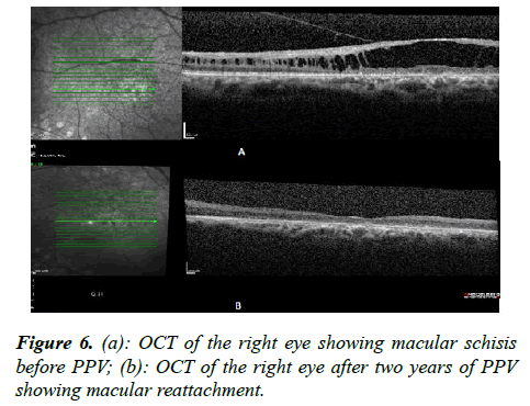 ophthalmic-eye-research-PPV