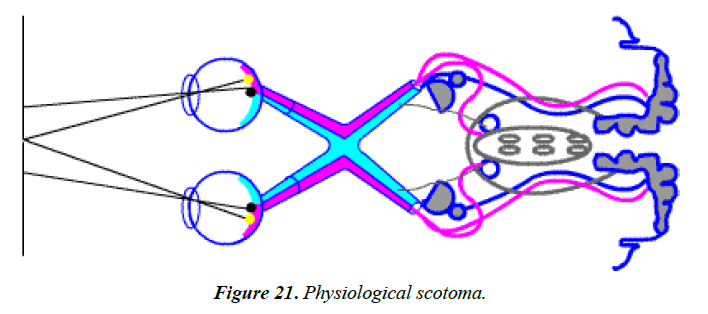 ophthalmic-eye-research-Physiological-scotoma