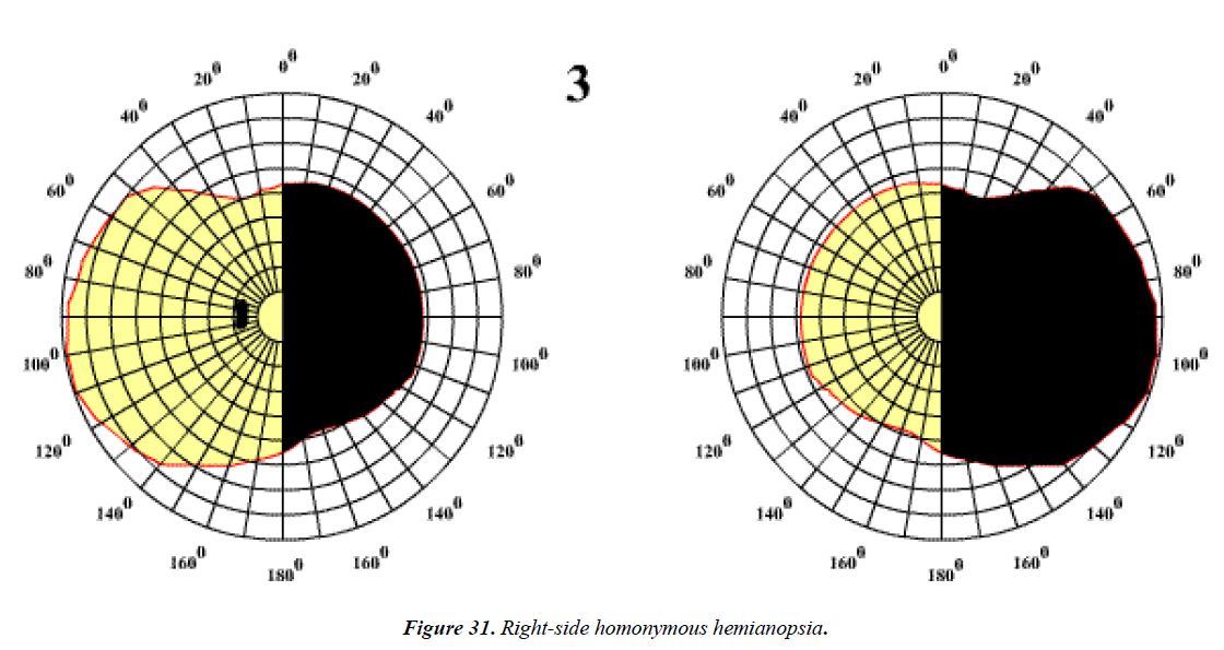 ophthalmic-eye-research-Right-side-homonymous