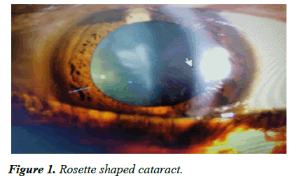 ophthalmic-eye-research-Rosette