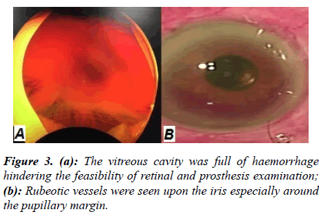 ophthalmic-eye-research-Rubeotic