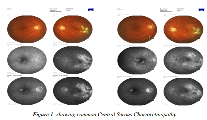 ophthalmic-eye-research-Serous-Chorioretinopathy