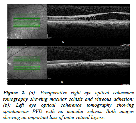 ophthalmic-eye-research-coherence