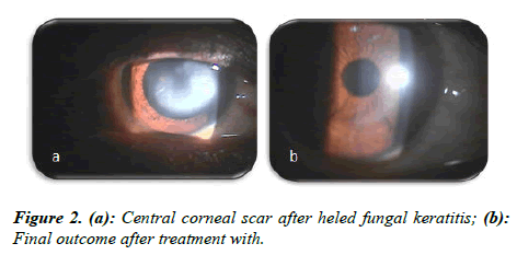 ophthalmic-eye-research-corneal