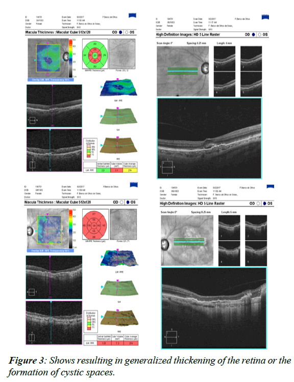 ophthalmic-eye-research-cystic-spaces