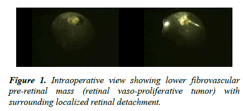 ophthalmic-eye-research-fibrovascular