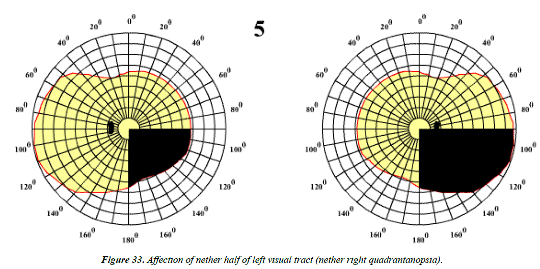 ophthalmic-eye-research-half-left-visual-tract