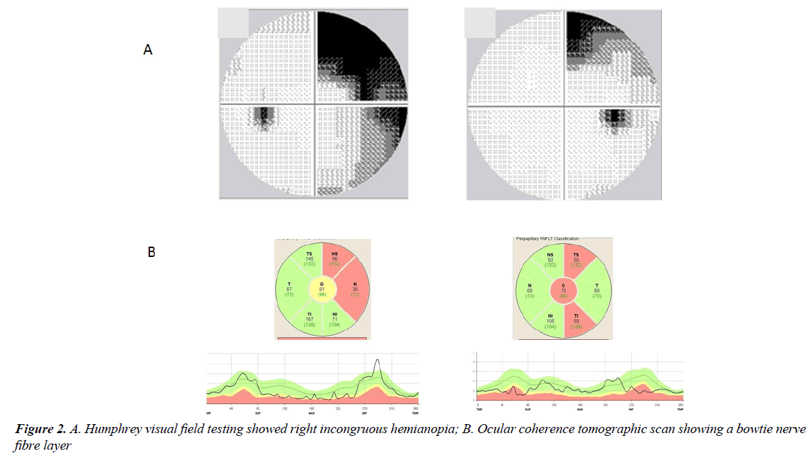 ophthalmic-eye-research-incongruous-hemianopia