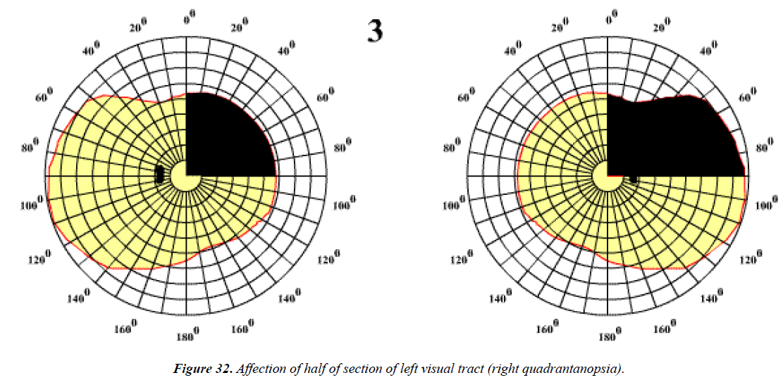 ophthalmic-eye-research-left-visual-tract