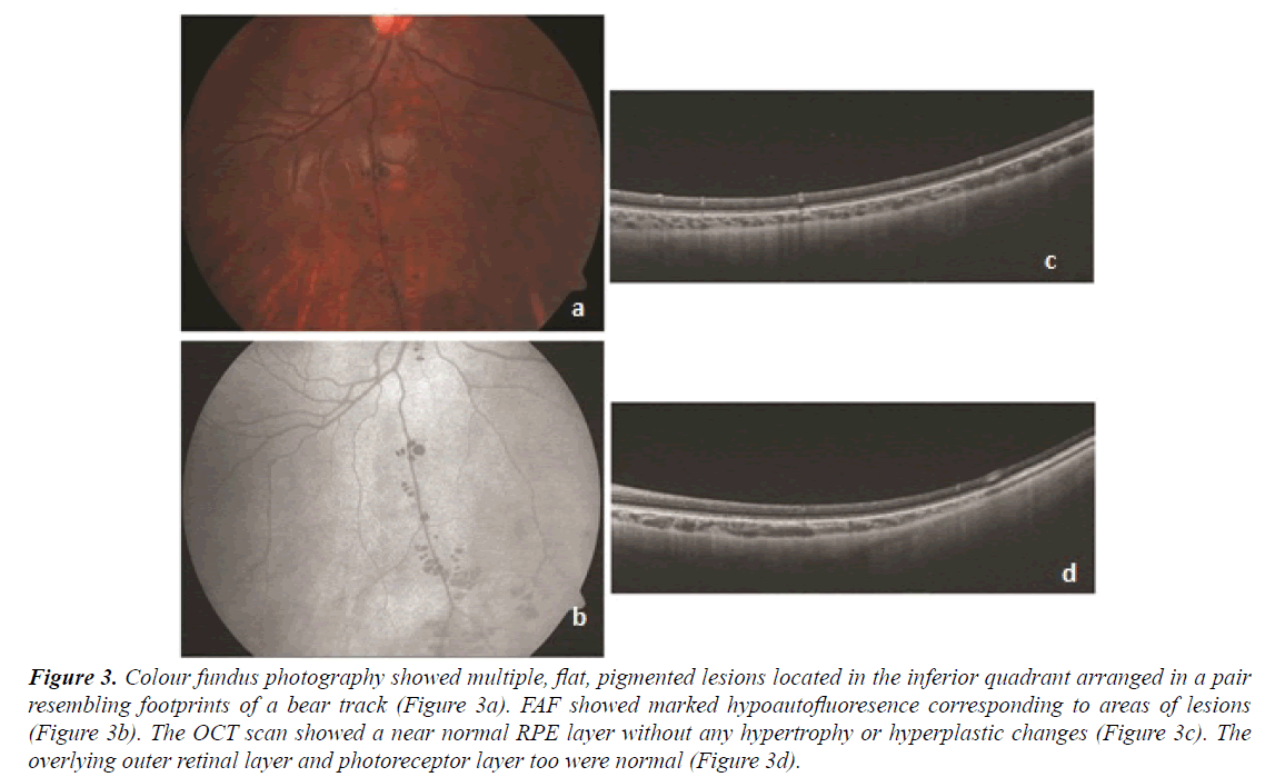 ophthalmic-eye-research-pigmented-lesions