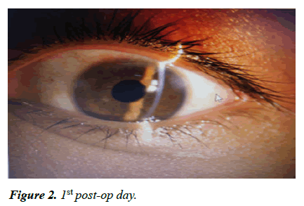 ophthalmic-eye-research-post