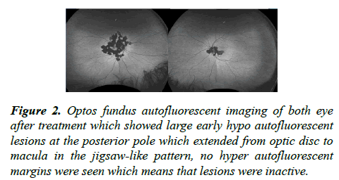 ophthalmic-eye-research-posterior