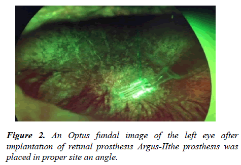 ophthalmic-eye-research-prosthesis