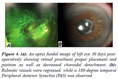 ophthalmic-eye-research-temporal