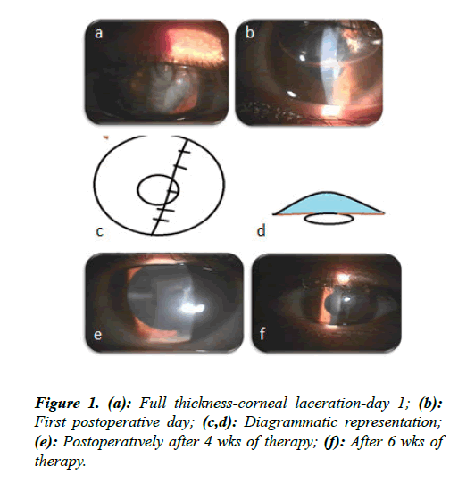 ophthalmic-eye-research-thickness