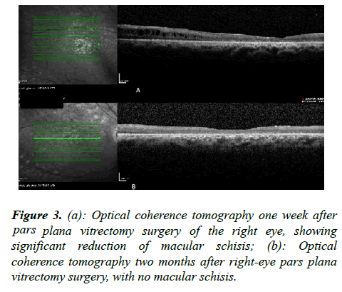 ophthalmic-eye-research-tomography