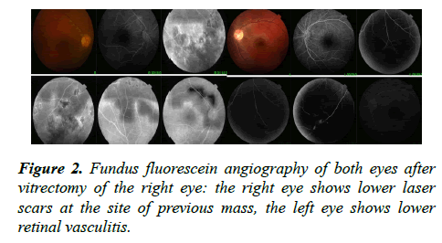 ophthalmic-eye-research-vitrectomy