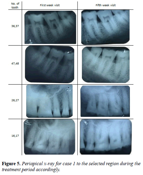 oral-medicine-and-toxicology-Periapical-x-ray