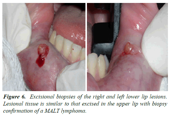 oral-medicine-toxicology-MALT-lymphoma