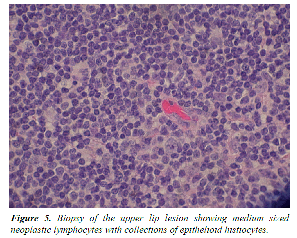 oral-medicine-toxicology-epithelioid-histiocytes